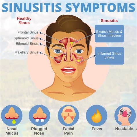 sinusitis sintomas
